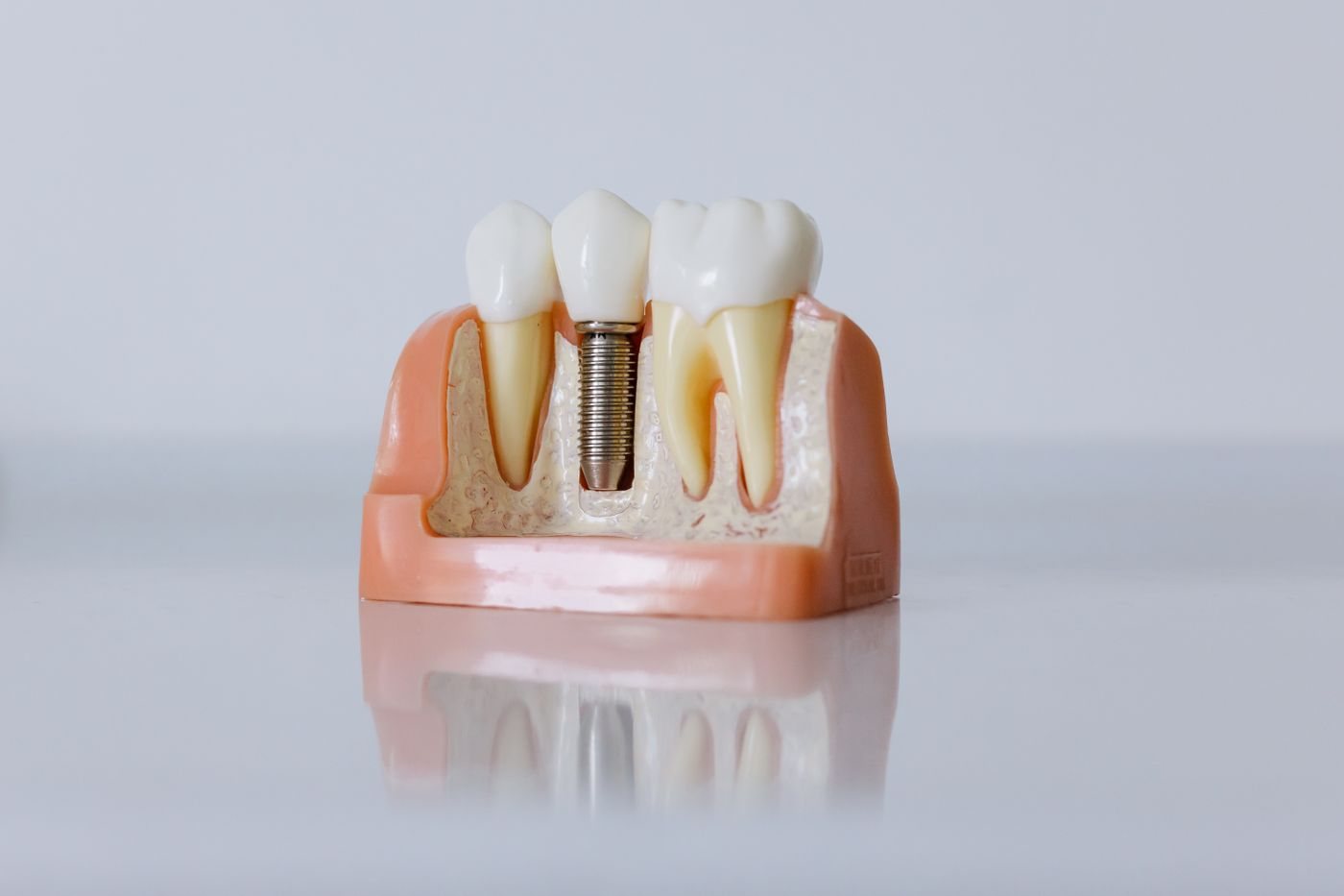 Modelo dentário mostrando implante